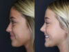 Revision Rhinoplasty case #5304 slider thumbnail