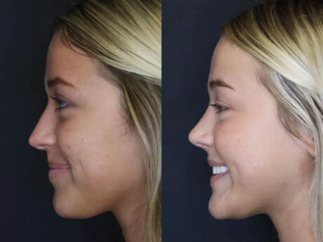 Revision Rhinoplasty case #5304