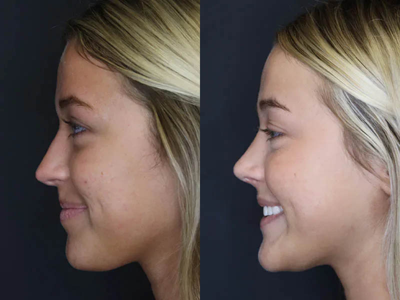 Revision Rhinoplasty case #5304