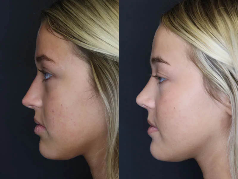 Revision Rhinoplasty case #5304