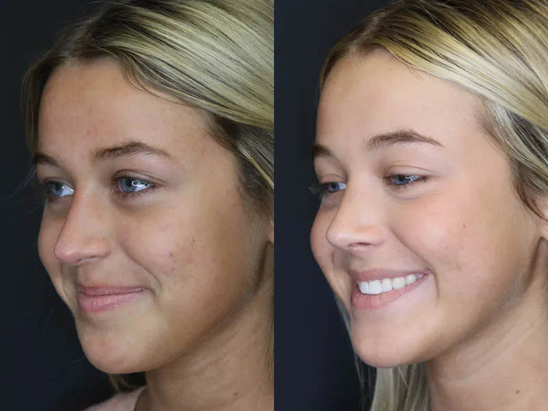 Revision Rhinoplasty case #5304