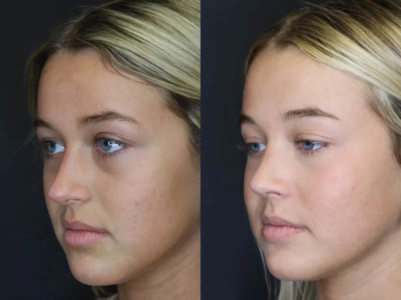 Revision Rhinoplasty case #5304