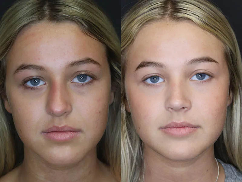 Revision Rhinoplasty case #5304