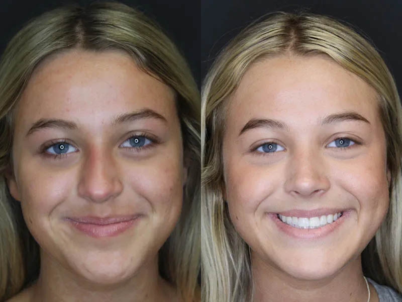 Revision Rhinoplasty case #5304