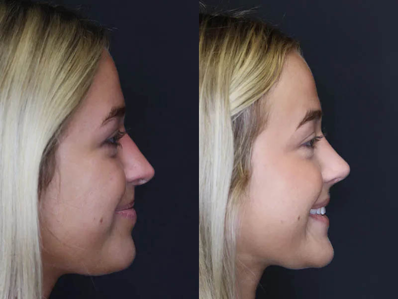 Revision Rhinoplasty case #5304