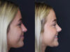 Revision Rhinoplasty case #5304 slider thumbnail
