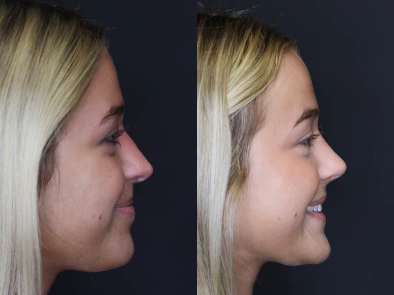 Revision Rhinoplasty case #5304