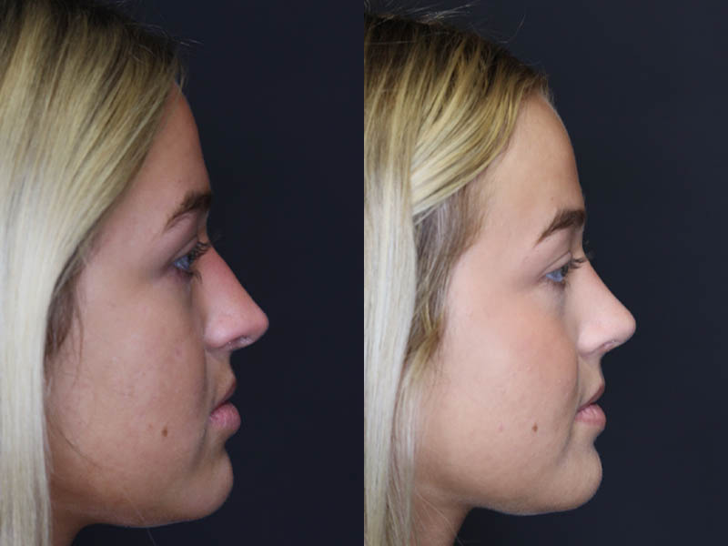 Revision Rhinoplasty case #5304