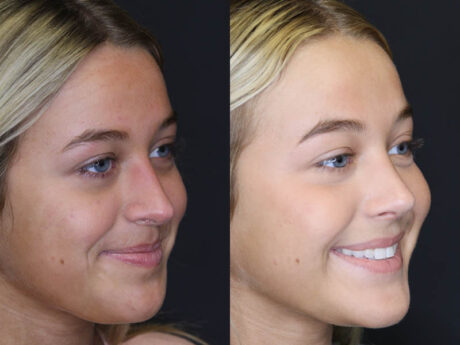 Revision Rhinoplasty case #5304