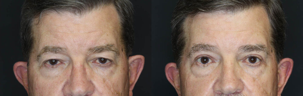 Blepharoplasty case #5280