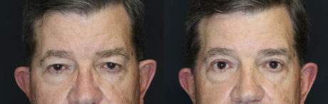 Blepharoplasty case #5280