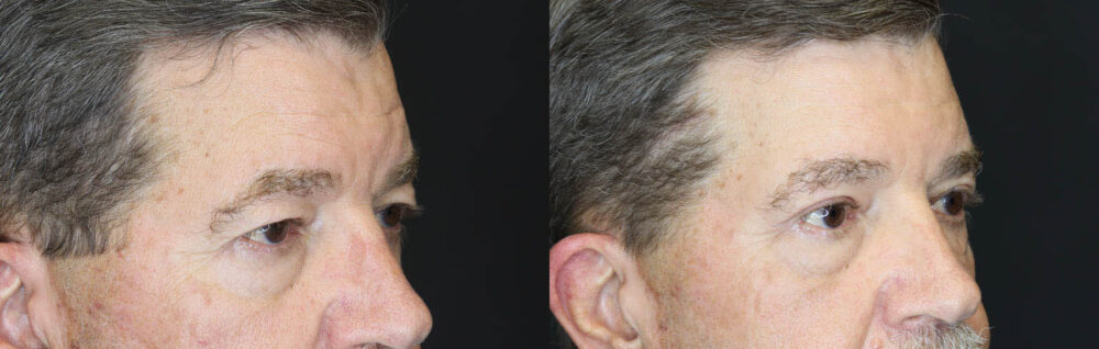 Blepharoplasty case #5280