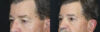 Blepharoplasty case #5280 slider thumbnail