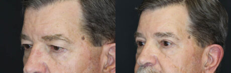 Blepharoplasty case #5280