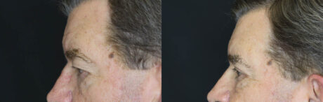 Blepharoplasty case #5280