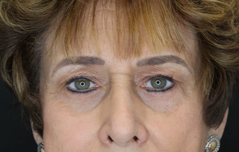 Blepharoplasty case #5965