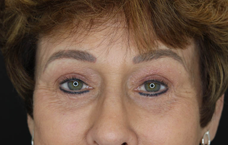 Blepharoplasty case #5965