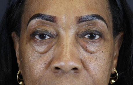 Blepharoplasty case #5732