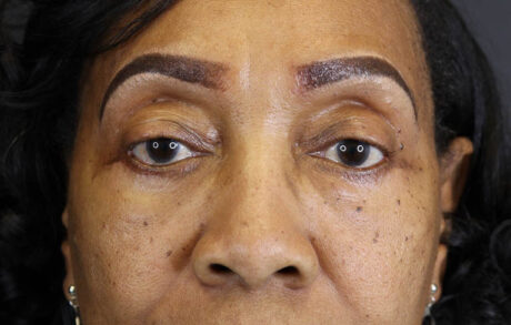 Blepharoplasty case #5732