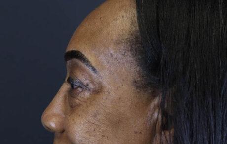 Blepharoplasty case #5732