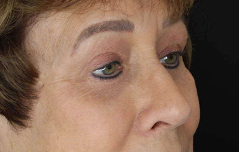 Blepharoplasty case #5965