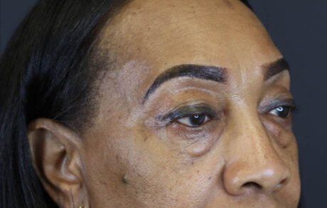 Blepharoplasty case #5732