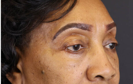 Blepharoplasty case #5732