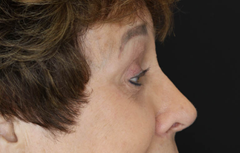 Blepharoplasty case #5965