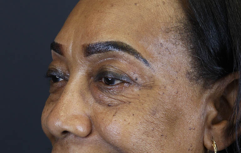 Blepharoplasty case #5732