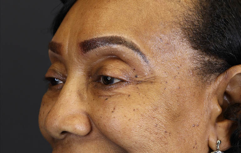 Blepharoplasty case #5732