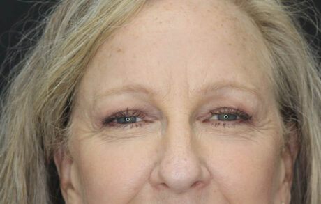 Blepharoplasty case #5714