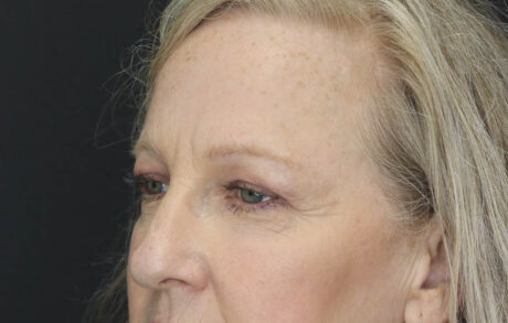 Blepharoplasty case #5714