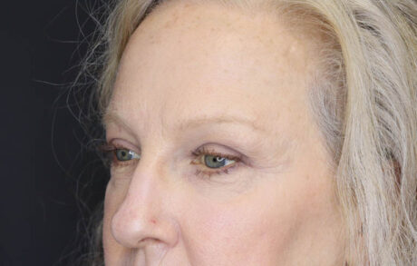 Blepharoplasty case #5714