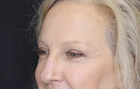 Blepharoplasty case #5714