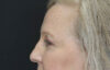 Blepharoplasty case #5714