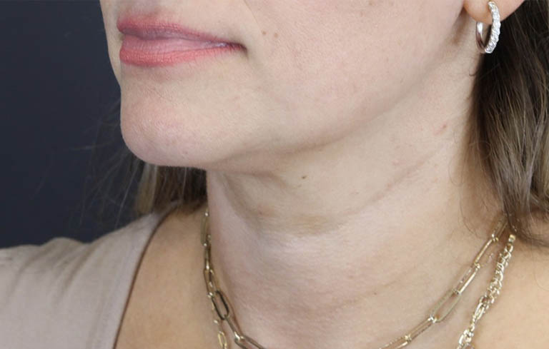 Facial Filler case #5978