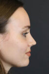 Rhinoplasty case #5813