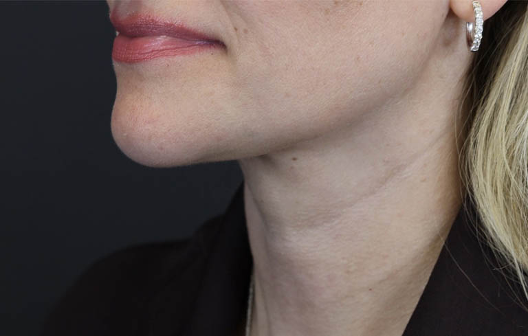 Facial Filler case #5978