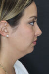 Facial Filler case #5993