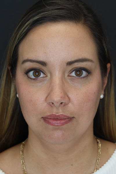 Facial Filler case #5993