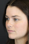 Skin Resurfacing case #5852