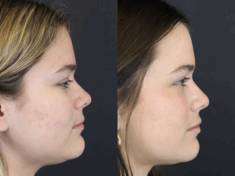 Skin Resurfacing case #5852
