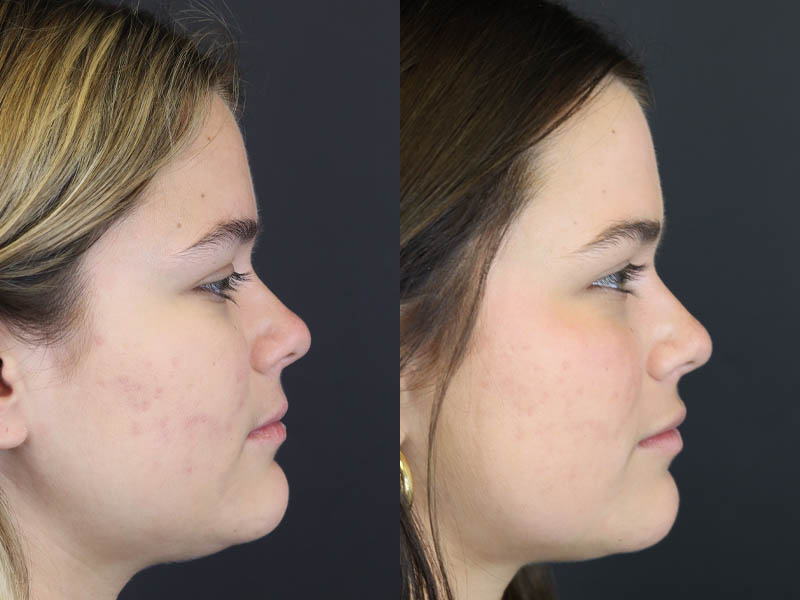 Skin Resurfacing case #5852