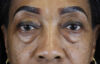 Blepharoplasty case #5732