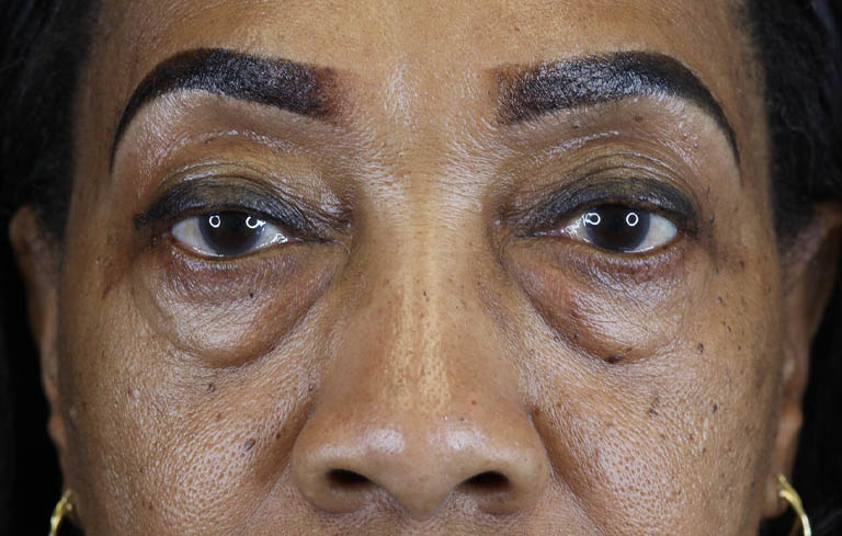 Blepharoplasty case #5732