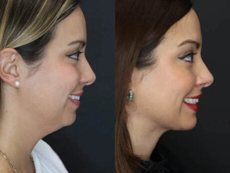 Facial Filler case #5993