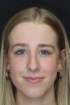 Rhinoplasty case #5794