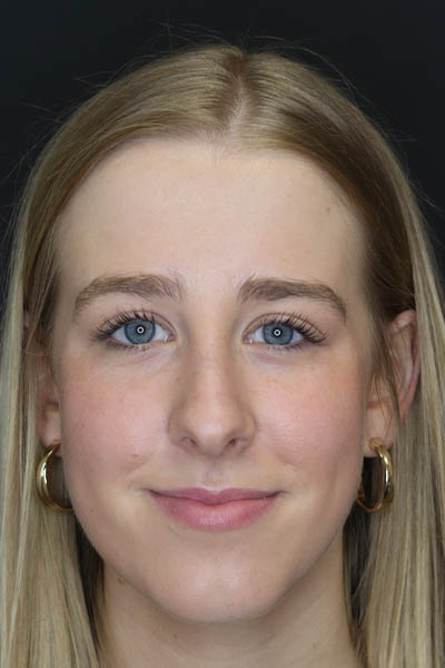 Rhinoplasty case #5794