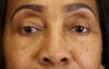 Blepharoplasty case #5732