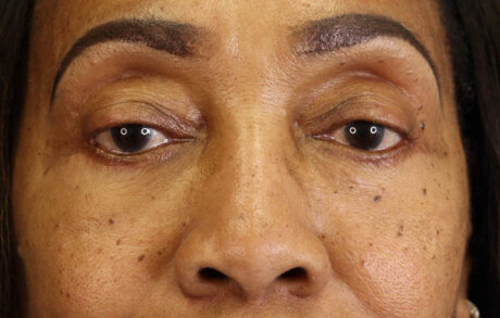 Blepharoplasty case #5732